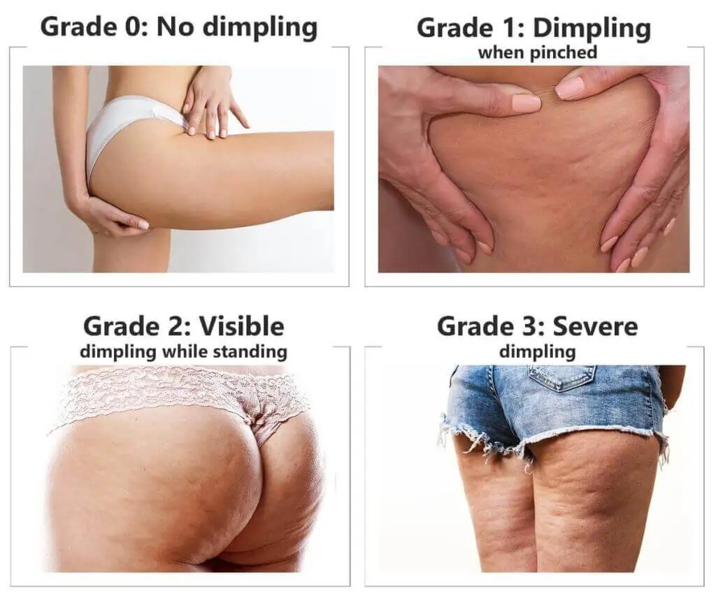 Representation of the stages of cellulite development Royal Tunbridge Wells